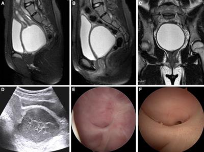 Case report: Hysteroscopy combined with a vaginal mold for severe recurrent vaginal adhesion and stenosis with pyocolpos after pelvic fracture in a 13-year-old female